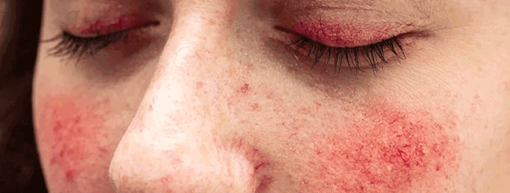 玫瑰痤瘡