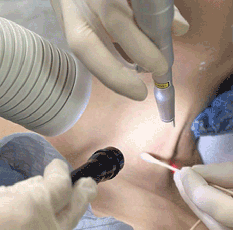 CO2激光治療儀器